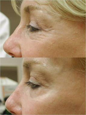 Fractional CO2 Laser Resurfacing