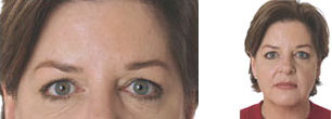 Botox Case Study 01 - After